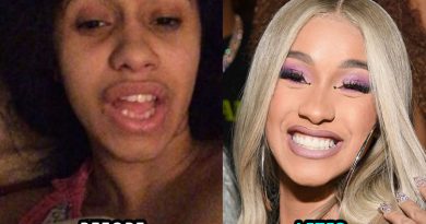 Cardi B's new teeth before and after