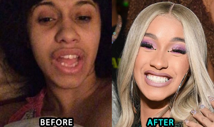 Cardi B's new teeth before and after