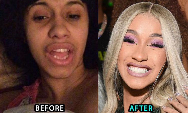 Cardi B before and after teeth surgery. 